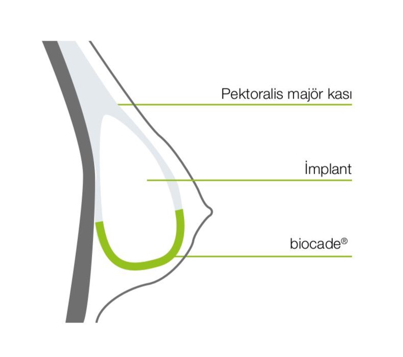 biocade® meme rekonstrüksiyonu cerrahi şema